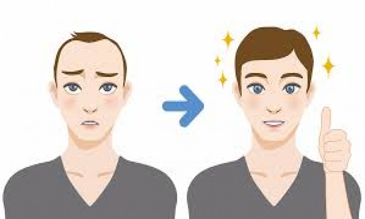 When is the best time to have a hair transplant.