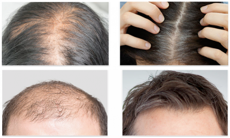 Revifol Review: New and Improved Hair Regrowth Supplement