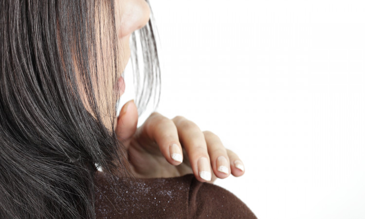 Best 5 tips to get rid of dandruff