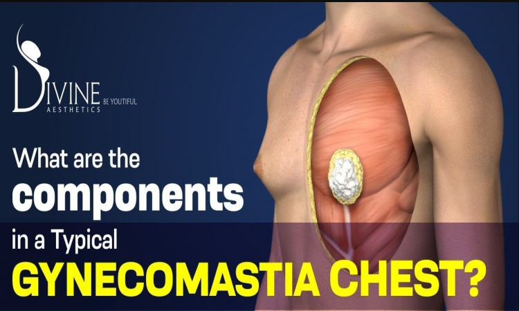 What are the Components in a Typical Gynecomastia Chest?