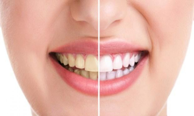 5 Great Tips to Remove Stains and Whiten Yellow Teeth