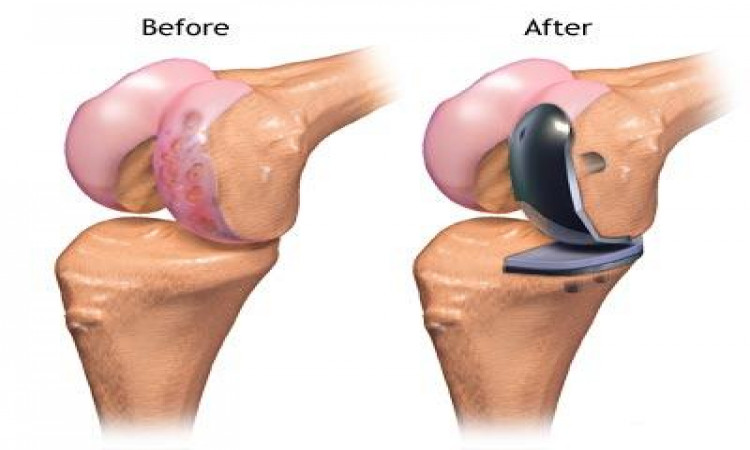 Understanding Meniscus Injury in Detail