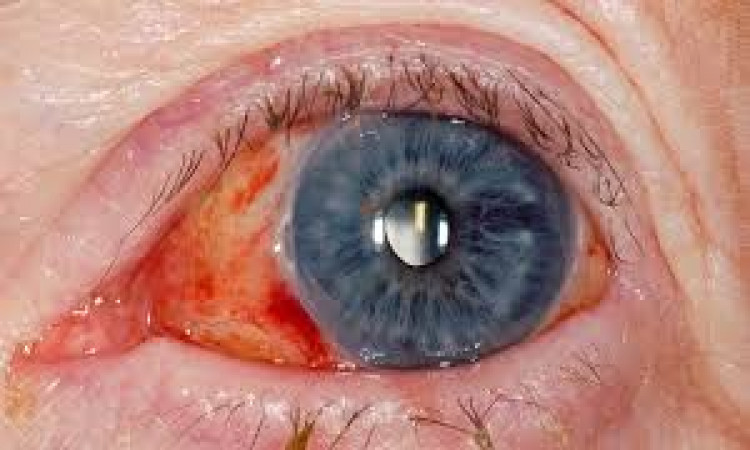 3 Surprising Benefits of Cataract Surgery