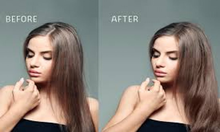 Which Hair Transplant Method Is Best For You?