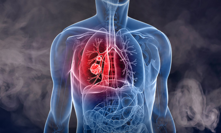 The Lung Cancer Symptoms People Ignore