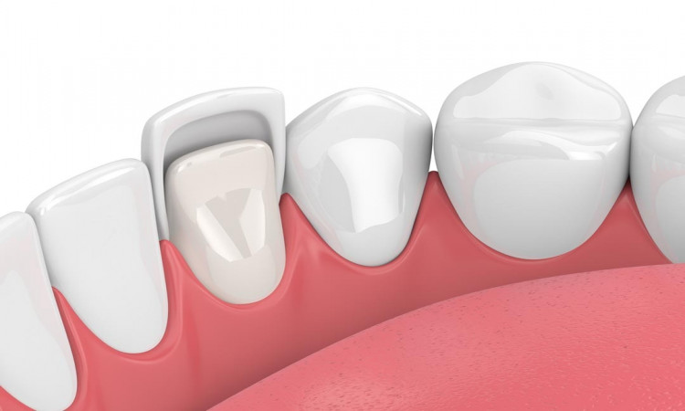What are The Benefits of Dental Veneers?