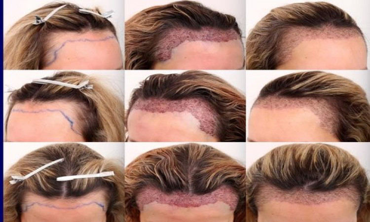 All you need to know about hair transplant success rate.
