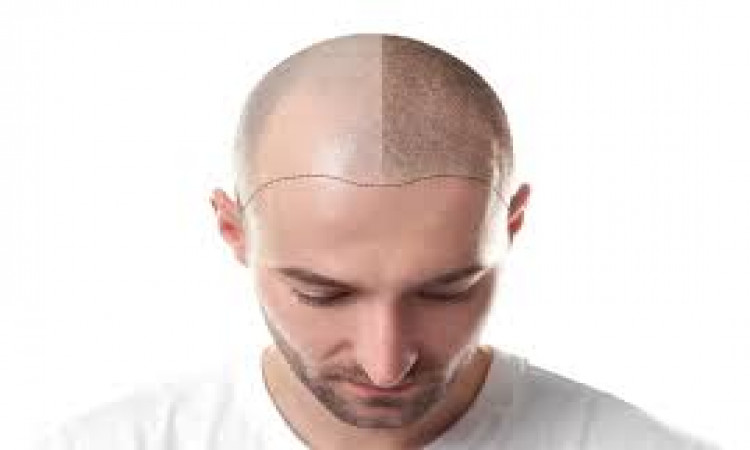 Learn about hair transplantation and enhance your beauty!