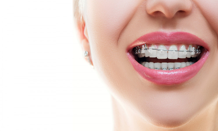 Feel More Confident With Clear Ceramic Braces