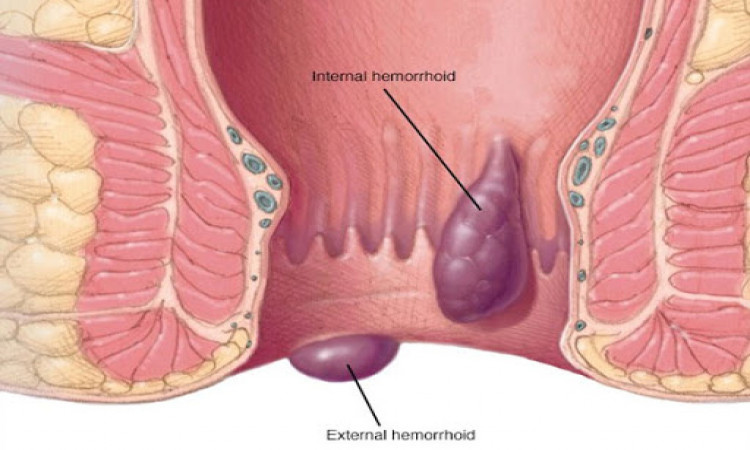 9 common questions answered about Piles surgery.