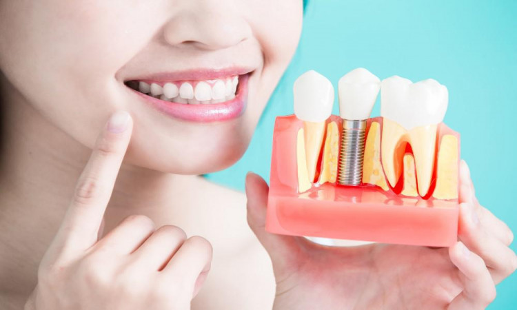 Everything you should Know about Dental Implants Procedure