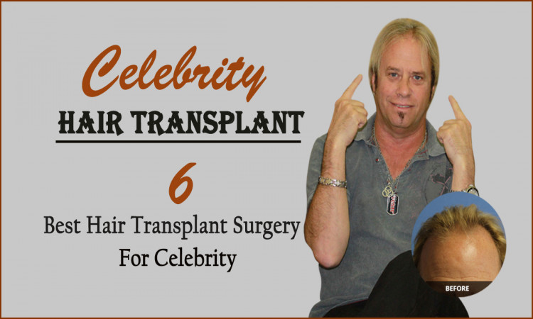 Celebrity Hair Transplant- 6 Hair Transplant Surgery